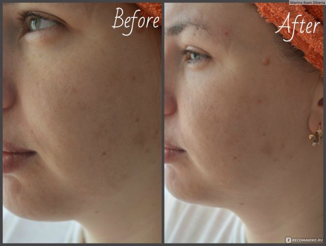 Serum Bielenda xanh dương cho da khô, mất nước,da nhạy cảm