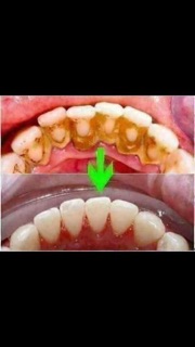 BỘT TRẮNG RĂNG TWHITE
