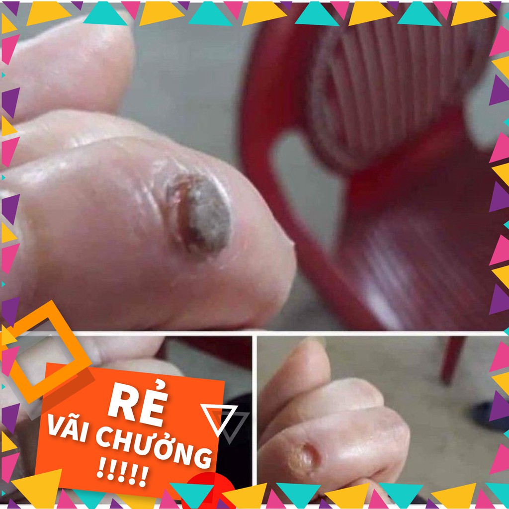 MỤN CÓC, MỤN CƠM, VẾT CHAI SẦN - sỉ nhiều ib shop | BigBuy360 - bigbuy360.vn