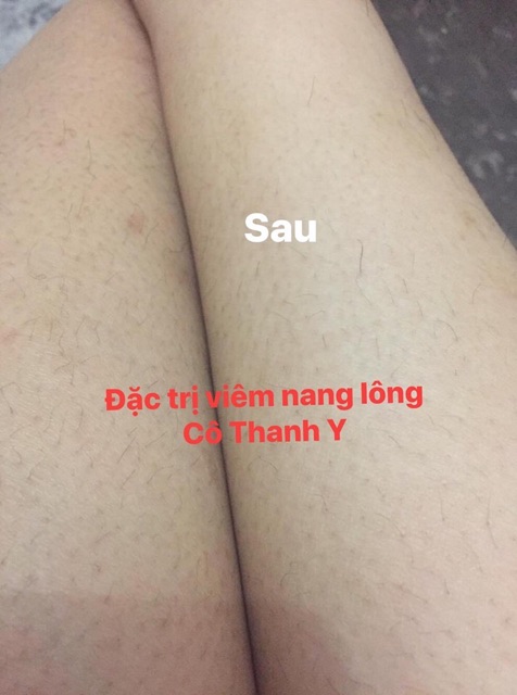 01 kem bôi #viêm nang lông | BigBuy360 - bigbuy360.vn