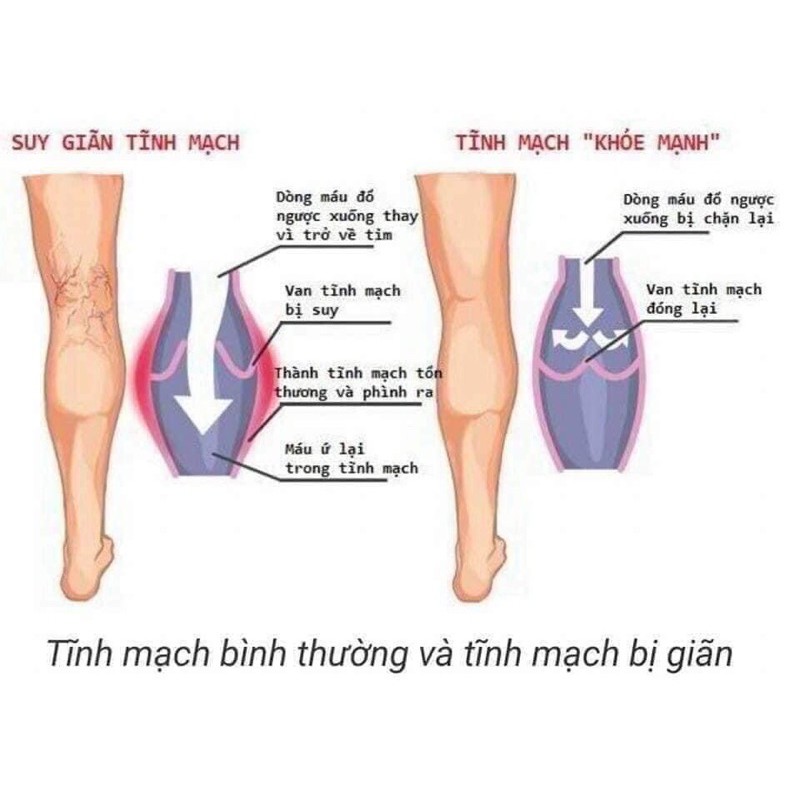 Kem và viên hỗ trợ điều trị suy giãn tĩnh mạch Caruso’s