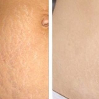 KEM MỜ SẸO NGA KLIRVIN