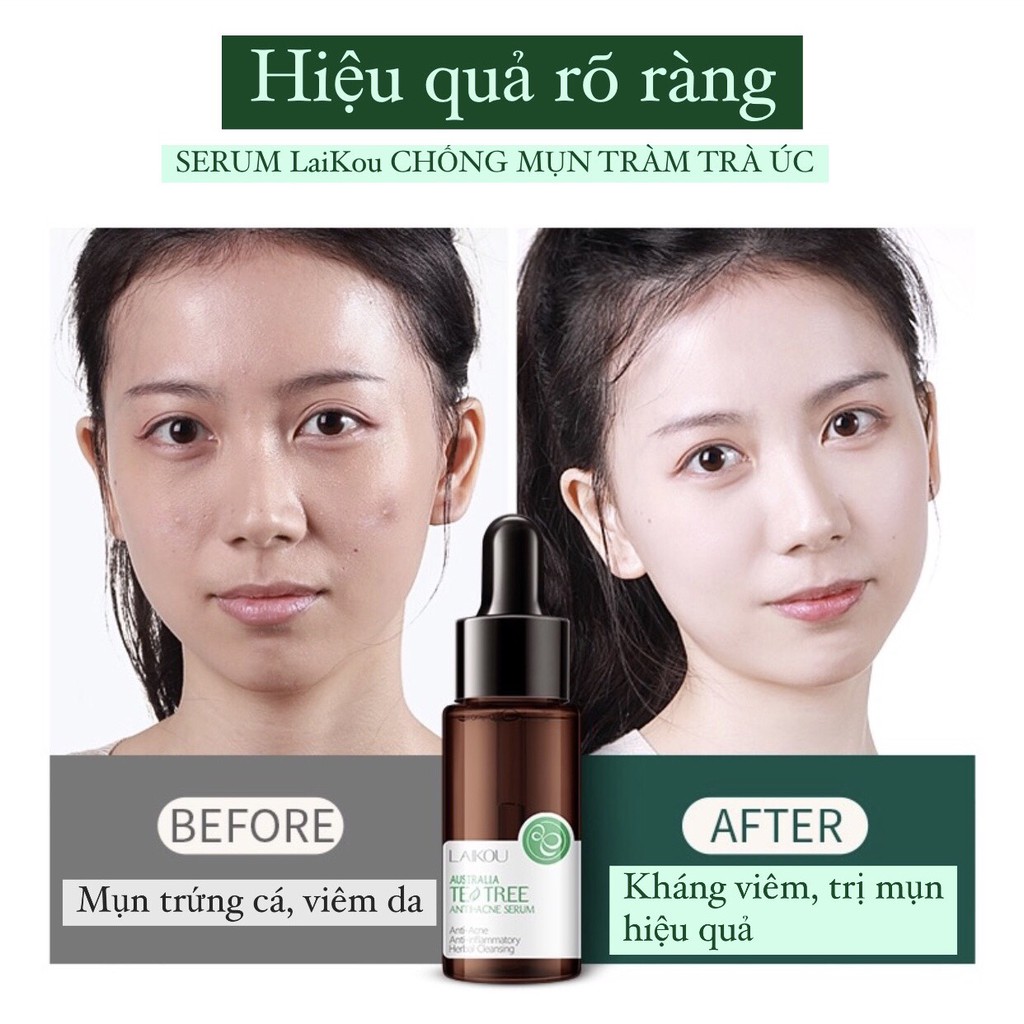 Serum Tràm Trà Úc Hỗ Trợ Giảm Mụn | BigBuy360 - bigbuy360.vn
