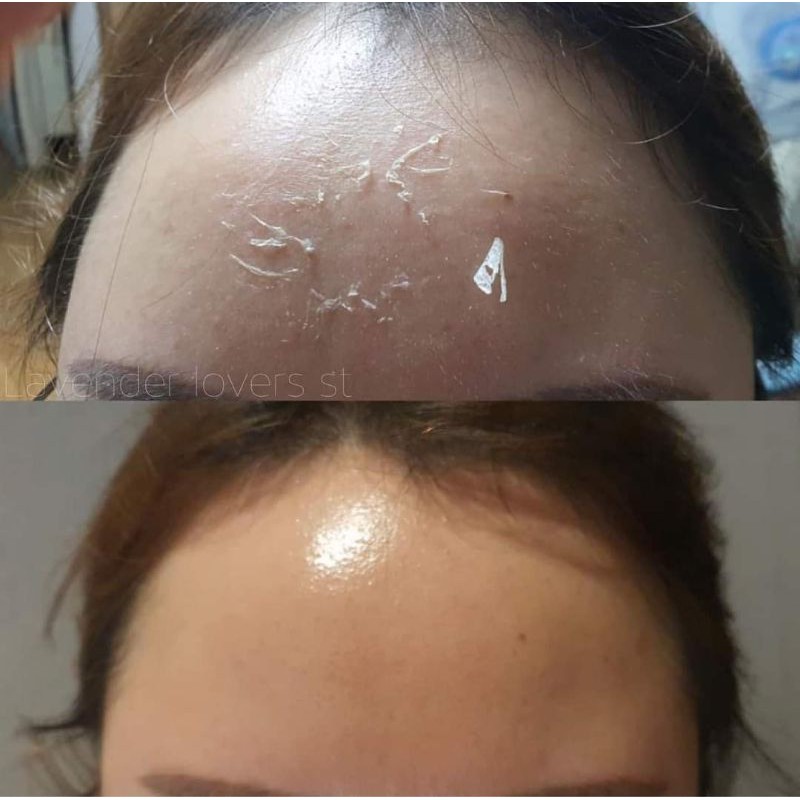 peel da liệu trình 2 lầnm