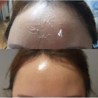 peel da liệu trình 2 lầnm