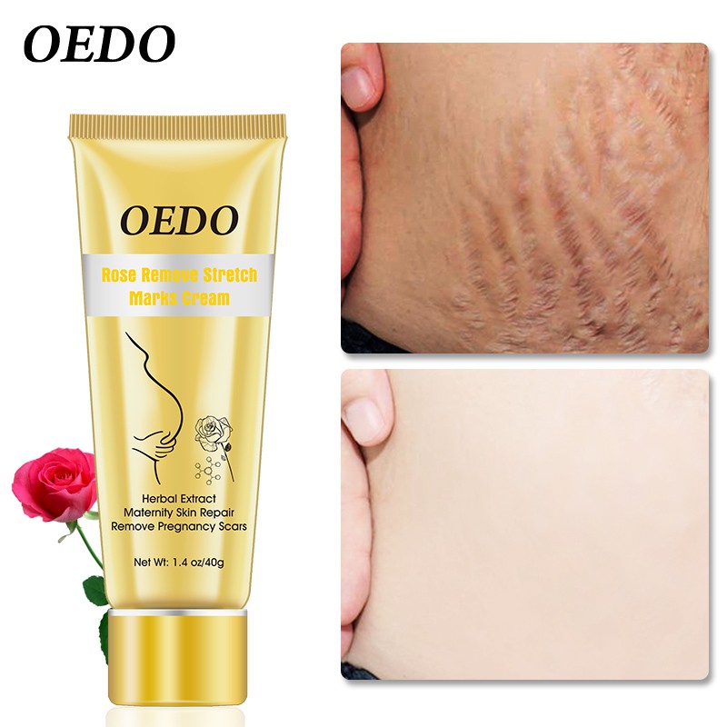 OEDO Rose Remove Stretch Marks Cream 40g | BigBuy360 - bigbuy360.vn