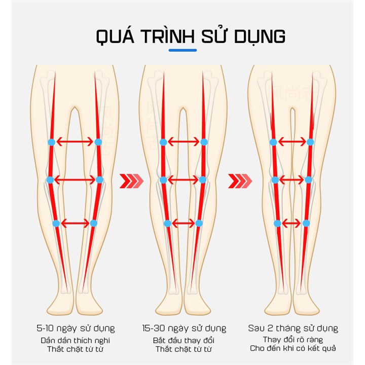 ĐAI CHỈNH CHÂN VÒNG KIỀNG BẰNG HƠI NHẸ NHÀNG, ÊM ÁI CHO BÉ