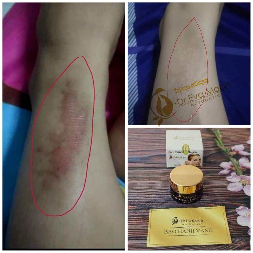 Kem Sẹo, Kem Sẹo Thâm, Rỗ Collagen Dr.EvaMoon CHÍNH HÃNG