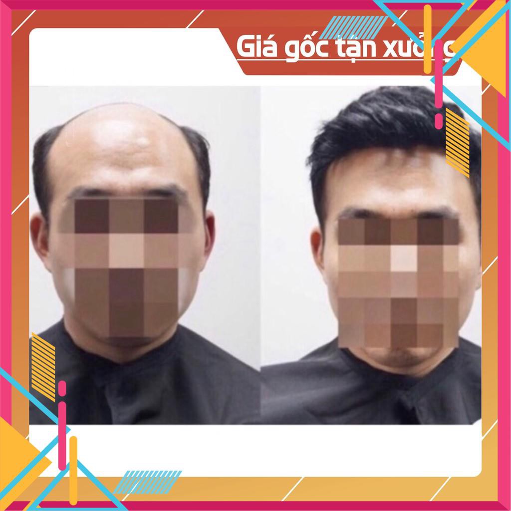 [Sale15%]  Tóc giả che hói nam