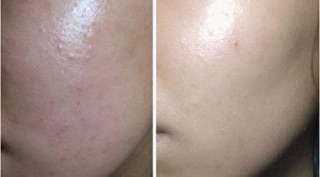 Kem  LaRoche-Posay Effaclar Duo+