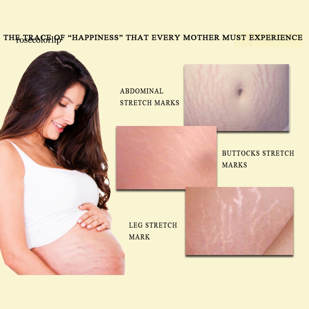 [Hàng mới về] Kem OEDO Hỗ Trợ Giảm sẹo và rạn da chống nếp nhăn cho phụ nữ mang thai | BigBuy360 - bigbuy360.vn