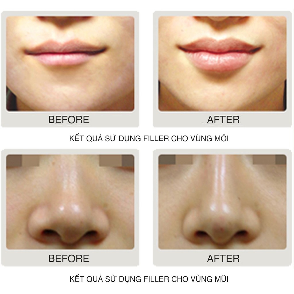 [Chính Hãng] The CHAEUM - Filler nằm trong TOP tiêu thụ trên thị trường (Hộp 2cc)