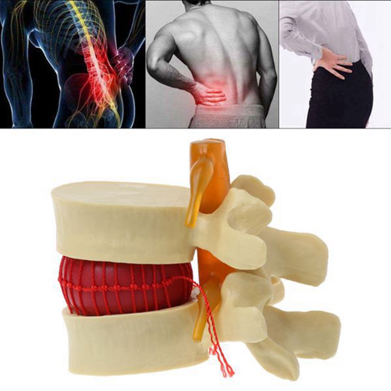 Mô hình đốt sống thắt lưng Giải phẫu cột sống thắt lưng Đĩa đệm thoát vị Công cụ giảng dạy giải phẫu Giải phẫu thắt lưng Mô hình đốt sống thắt lưng