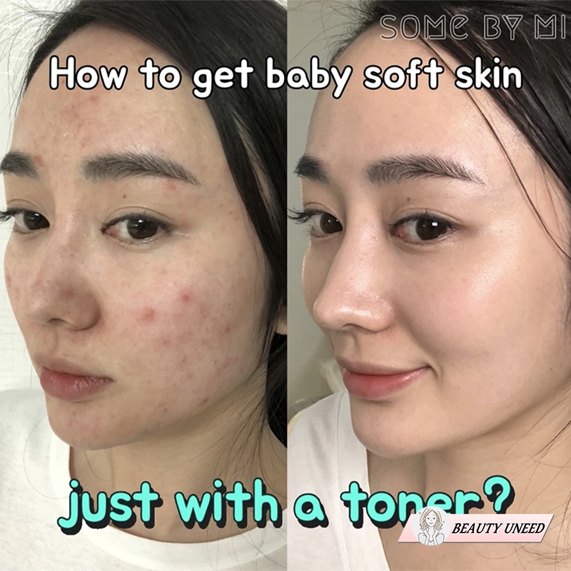 Nước Hoa Hồng Giảm Mụn Some By Mi AHA-BHA-PHA 30 Days Miracle Toner 150ml | BigBuy360 - bigbuy360.vn