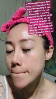 🔴RED PEEL TINGLE SERUM  CHAI FULL 35ml ,SAMPLE (10ml)🔴