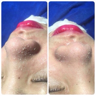 Ủ mụn sky pusk the acne imple mask