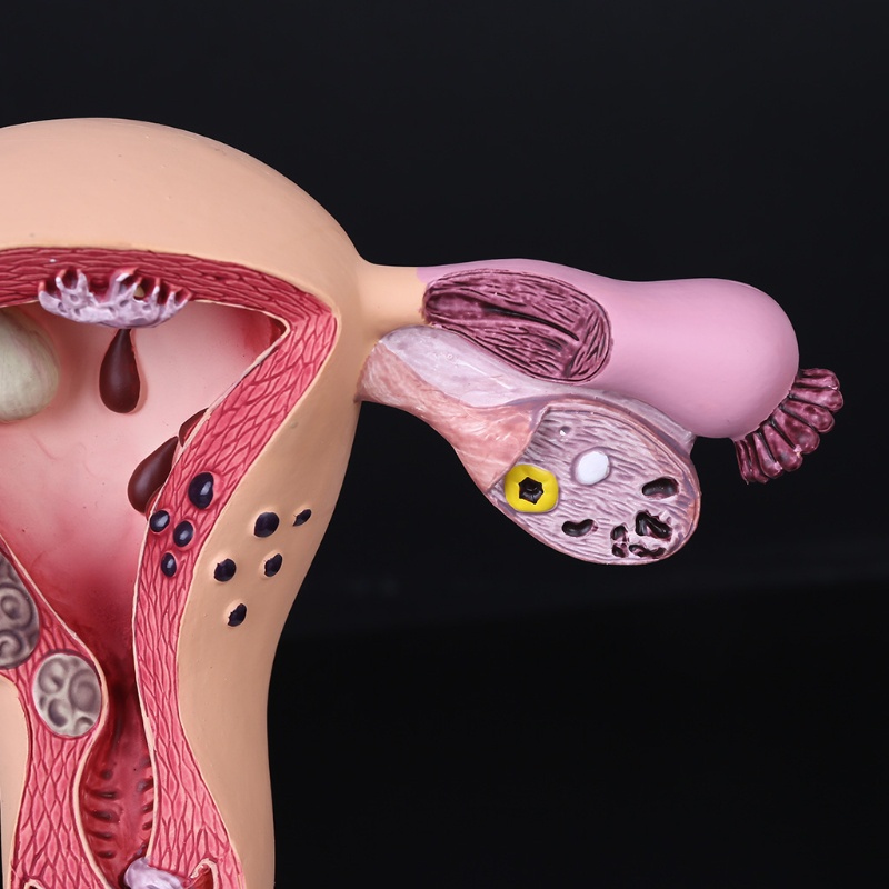 Mô Hình Lối Đi Bệnh tật Bằng Tiếng Ồn Người Phụ Nữ Uterus
