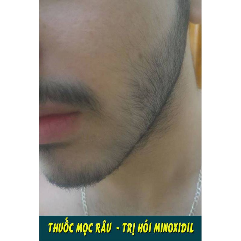 Dầu Dưỡng Râu - Chống Khô Da Khi Dùng Minoxidil 5%