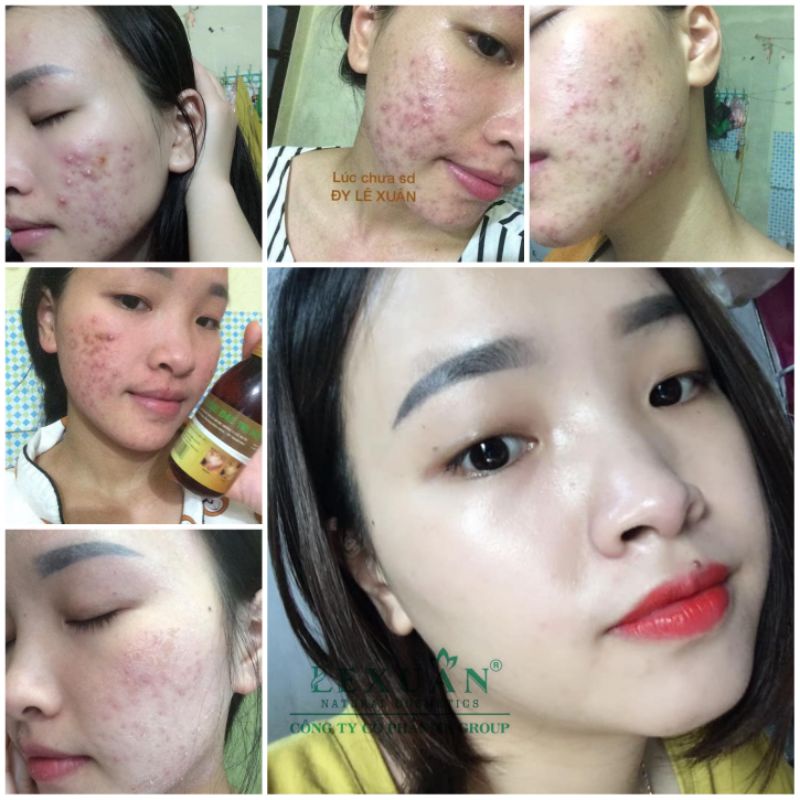 Tinh chất ngừa mụn trứng cá Lê Xuân 🍀Free ship☘️loại bỏ mụn đầu đen, mụn ẩn, mụn bọc,… | BigBuy360 - bigbuy360.vn