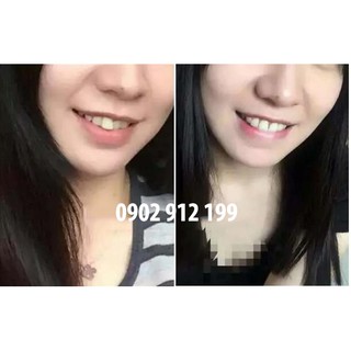 Bộ Niềng Răng Trainer Alignment