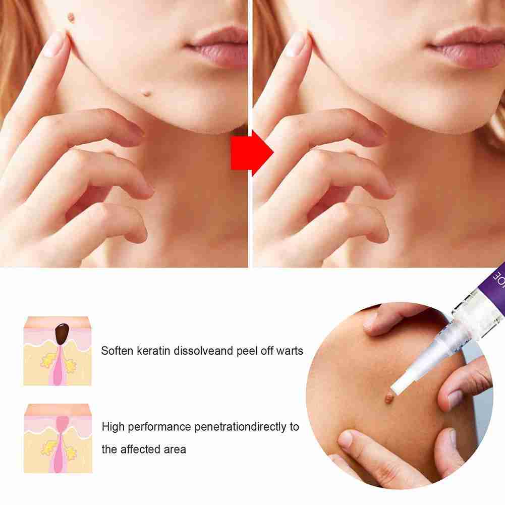 [Hàng mới về] Dung dịch loại bỏ mụn cóc / nốt ruồi A8T2