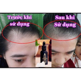 Tinh chất mọc tóc Cao Cấp Phúc Minh Khang