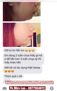 Tinh Chất Hàm Hô Miracle