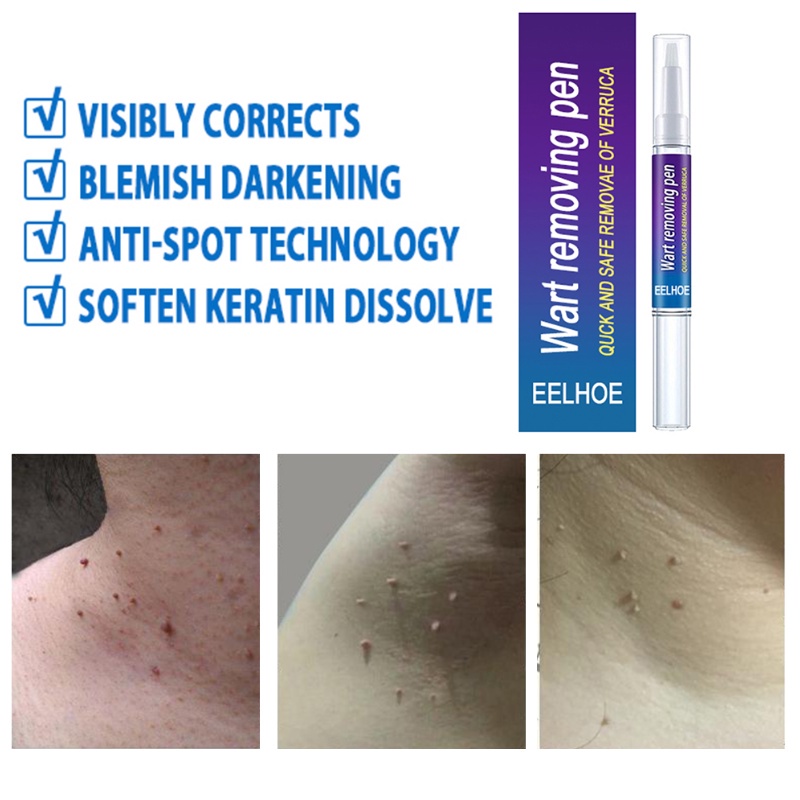 Bút Hỗ Trợ Giảm Mụn Thịt Thừa Cho Cơ Thể