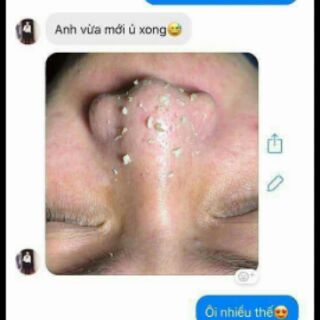Ủ mụn ohio hàn quốc