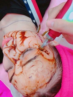 Cấy Hồng Sâm Baby