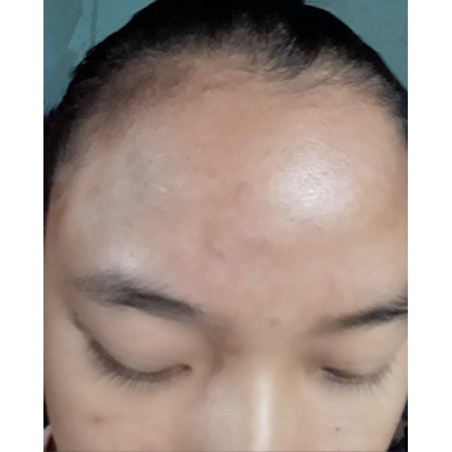 An Kim Tiền_Serum mụn_thể tích 5ml_dung dịch màu đen | BigBuy360 - bigbuy360.vn