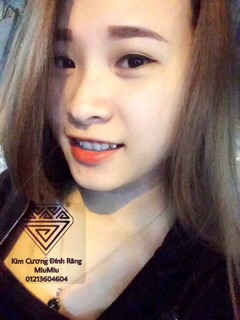 Kim cương nhân tạo đính răng