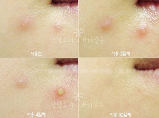 Chấm mụn BYE BYE BLEMISH DRYING LOTION