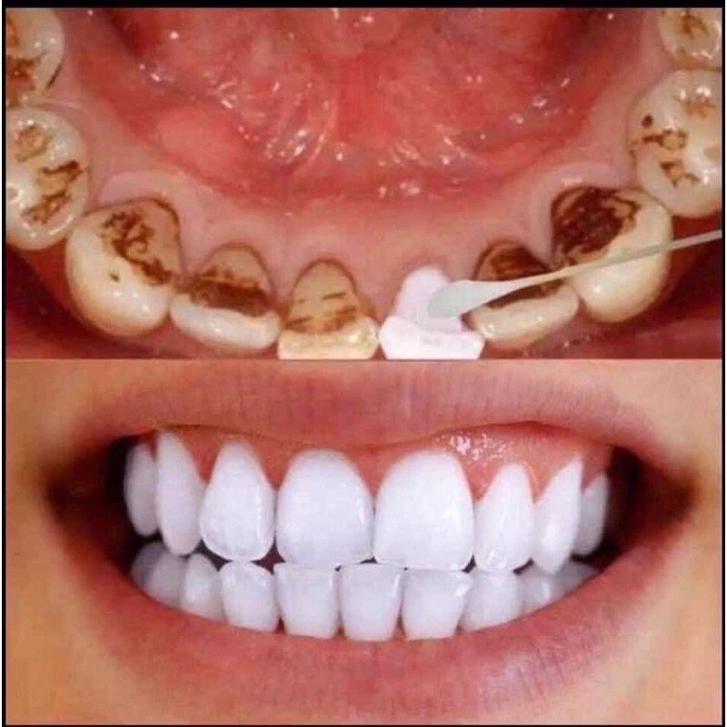 gel tẩy trắng răng