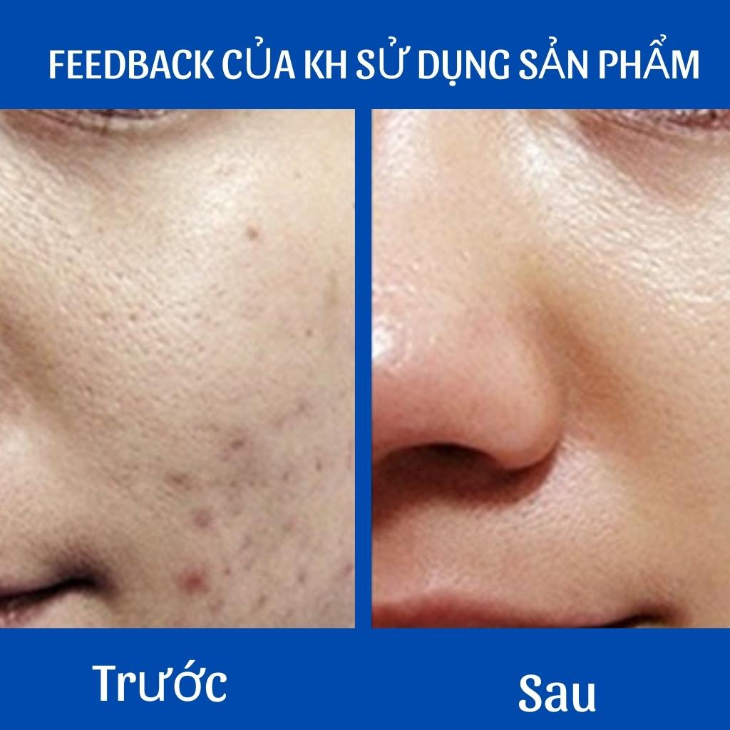 Serum Sẹo Lồi - Sẹo Lõm - Sẹo Rỗ Lâu Năm V3