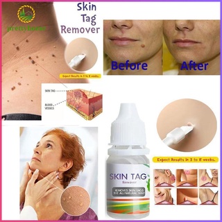 (Hàng Mới Về) Thuốc Mỡ Trị Mụn Cóc Dung Tích 10ml