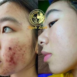 THUỐC THAY DA BẠCH LINH 02. CHUYÊN MỤN
