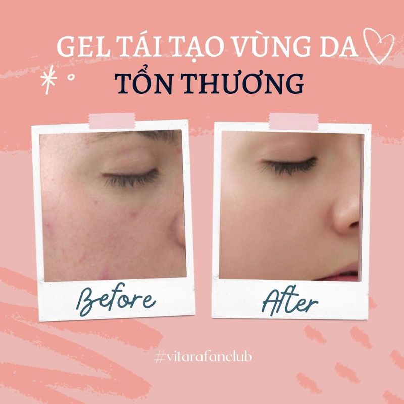 Gel Thoa Bỏng Tái tạo Da Tổn Thương Burnova gel pluss thái lan