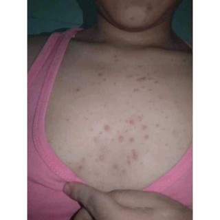 Xà phòng ngừa mụn lưng for back