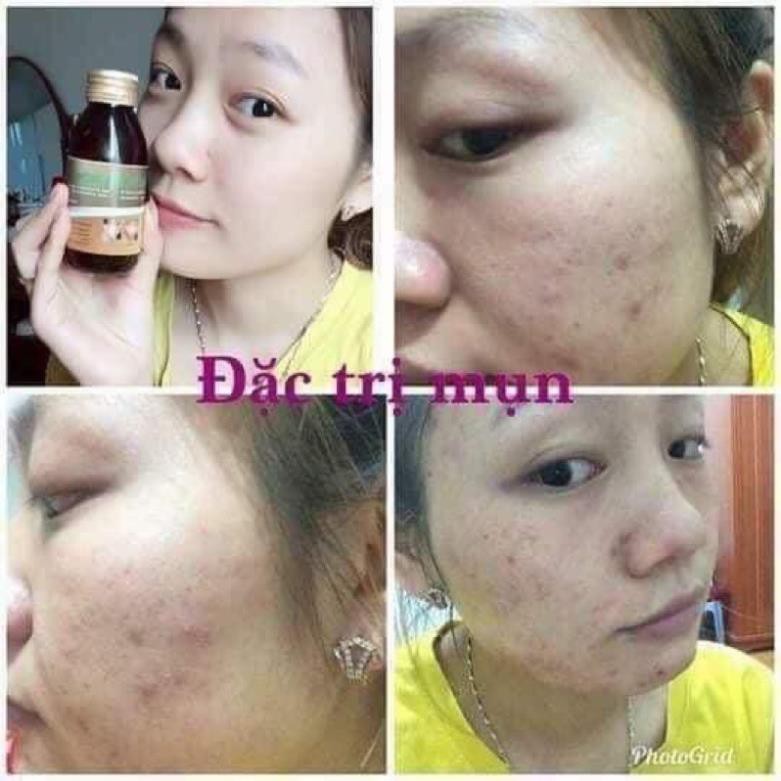 Tinh chất mụn Lê Xuân handmade 130ml | BigBuy360 - bigbuy360.vn