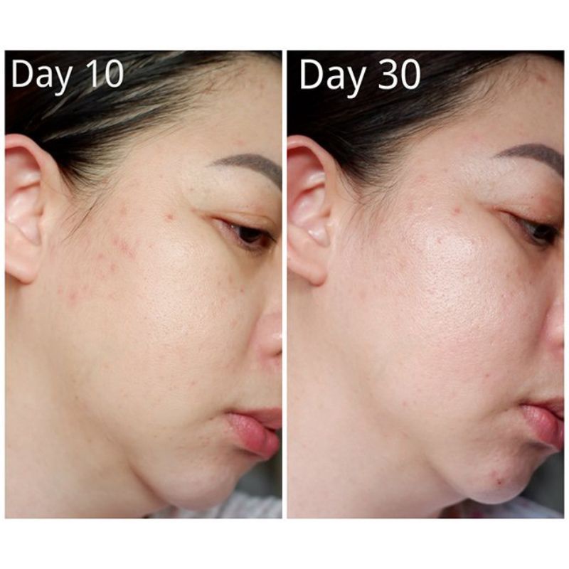 Tinh Chất Serum Rau Má Giảm Mụn, Phục Hồi Da Skin1004 Madagascar Centella Ampoule