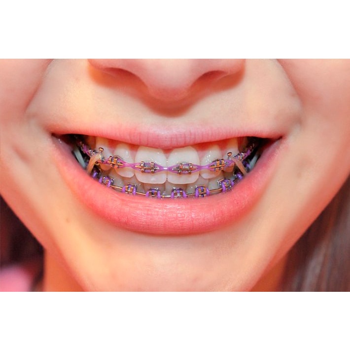 Cây móc chun liên hàm - Cây móc thun niềng răng dùng trong nha khoa