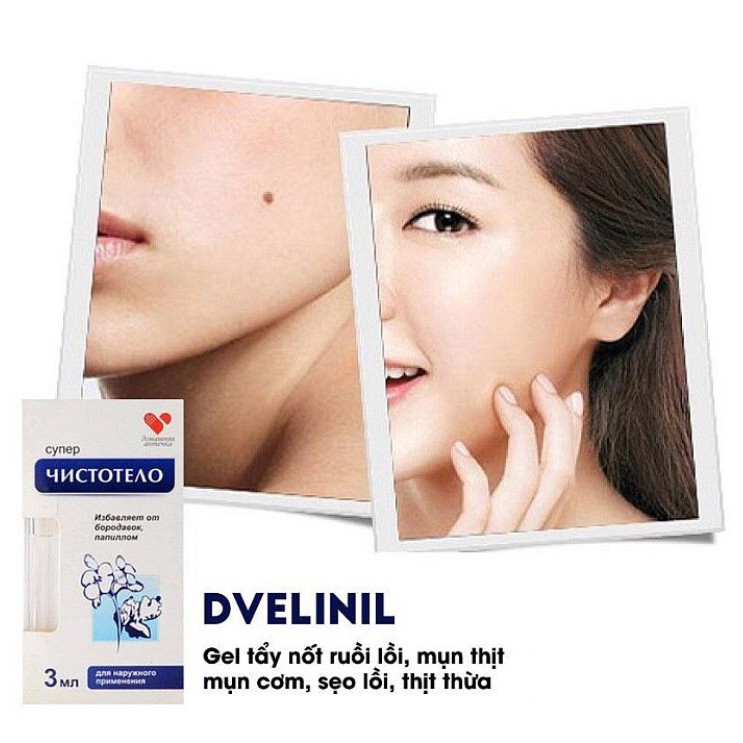 GEL TẨY NỐT RUỒI, MỤN CƠM, MỤN CÓC, SẸO LỒI, THỊT THỪA - Dvelinil của Nga