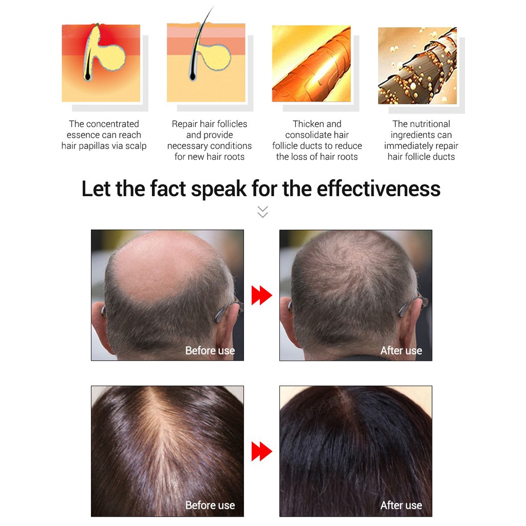 Tinh dầu kích thích mọc tóc LANBENA 20ml | BigBuy360 - bigbuy360.vn