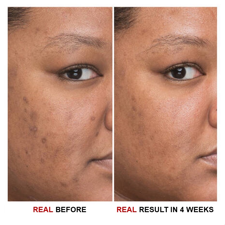 Serum Trắng Da, Mờ Thâm 20% Niacinamide 4% Vitamin C