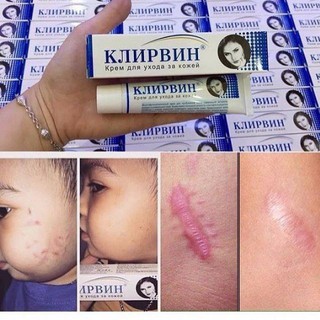 Kem trị sẹo mờ thâm rạn da nga klirvin