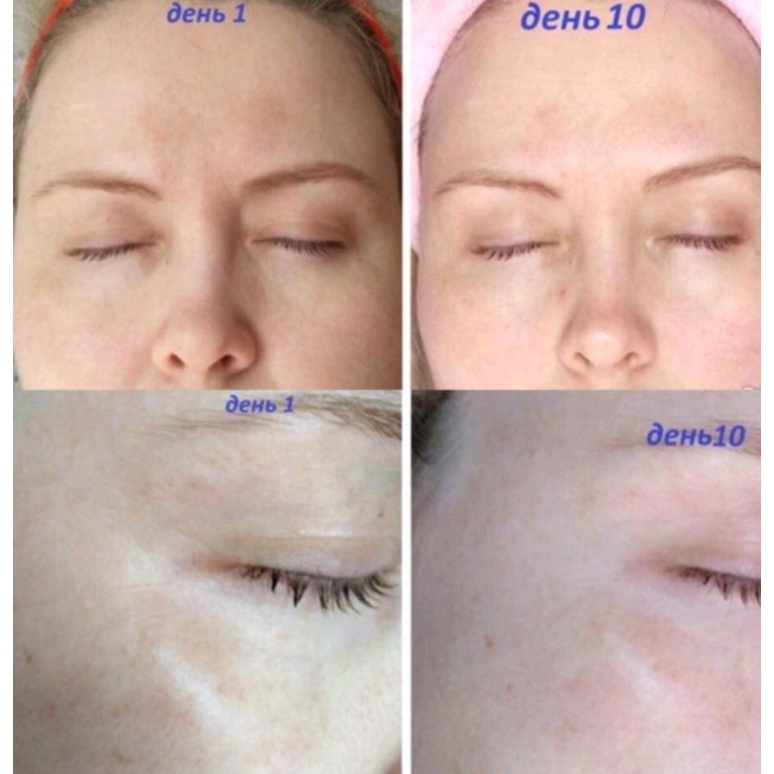 Liệu trình thay da teane trong 10 ngày