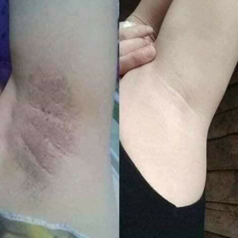 𝗧𝗵𝘂𝗼̂́𝗰 Khử mùi 𝗵𝗼̂𝗶 𝗻𝗮́𝗰𝗵.𝗵𝗼̂𝗶 𝗰𝗵𝗮̂𝗻 𝗹𝗮𝗻 𝗰𝗵𝗶