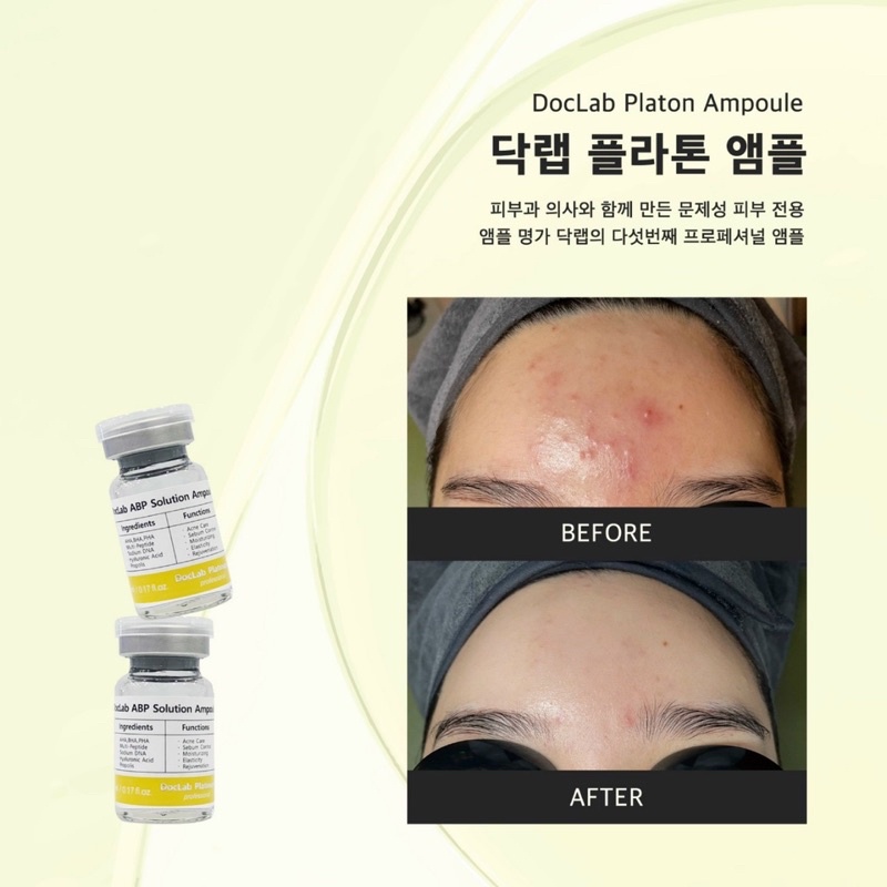 Lẻ 1 ống Tế bào gốc DOCLAB ABP Sodium Ampoule là vị cứu tinh giải quyết mọi vấn đề băn khoăn lo lắng về MỤN