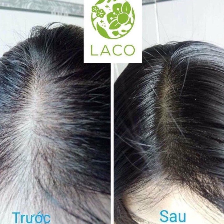 Serum kích thích mọc tóc AMLA LACO kích mọc tóc hiệu quả